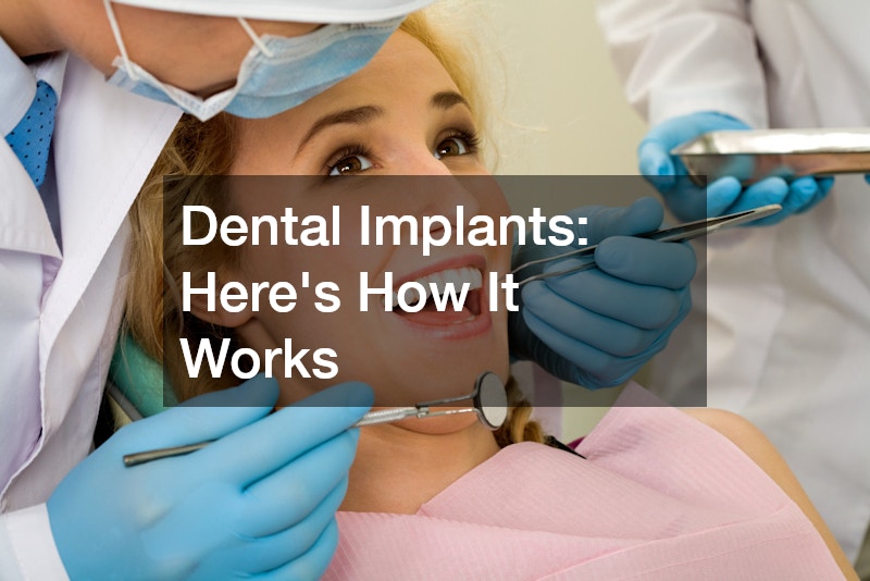 Dental Implants  Heres How It Works
